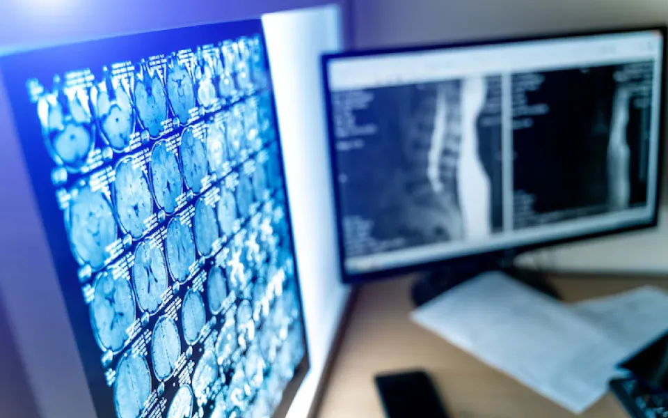 Close-up of a PC screen displaying multiple MRI scan images