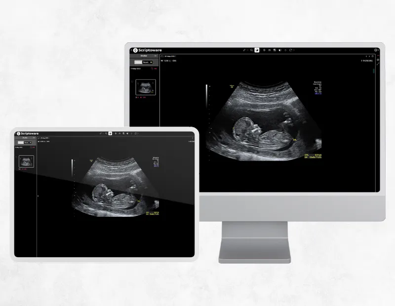 Gyn PACS platform showing ultrasound live report on PC monitor and tablet for accurate diagnosis.